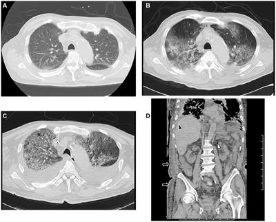 Case report: A case of acute exacerbation of interstitial pneumonia associated with TAFRO syndrome